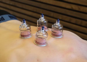 cupping physical therapy services at Kobza Gretna Nebraska